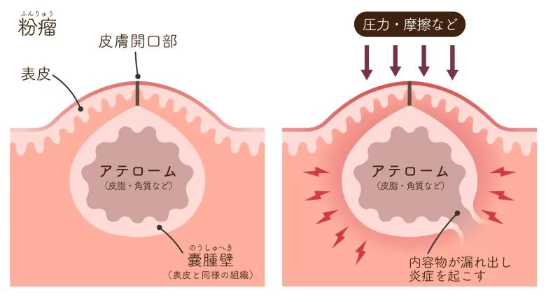 粉瘤